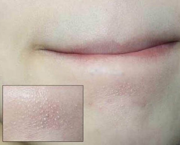  Trị Mụn Ẩn Và Mụn Cám Tại Sen Beauty